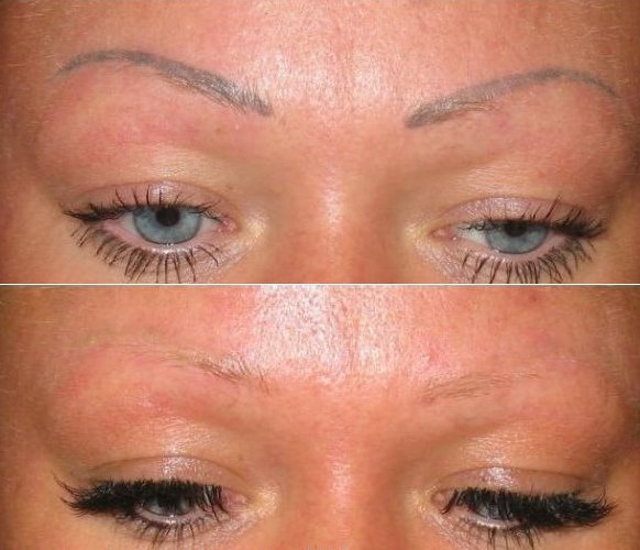 Unschones Permanent Make Up Laserentfernung In Berlin Bei Expert